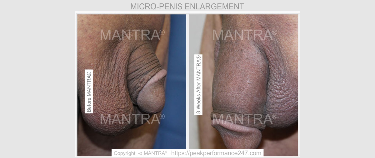 Penis Enlargement Before & After